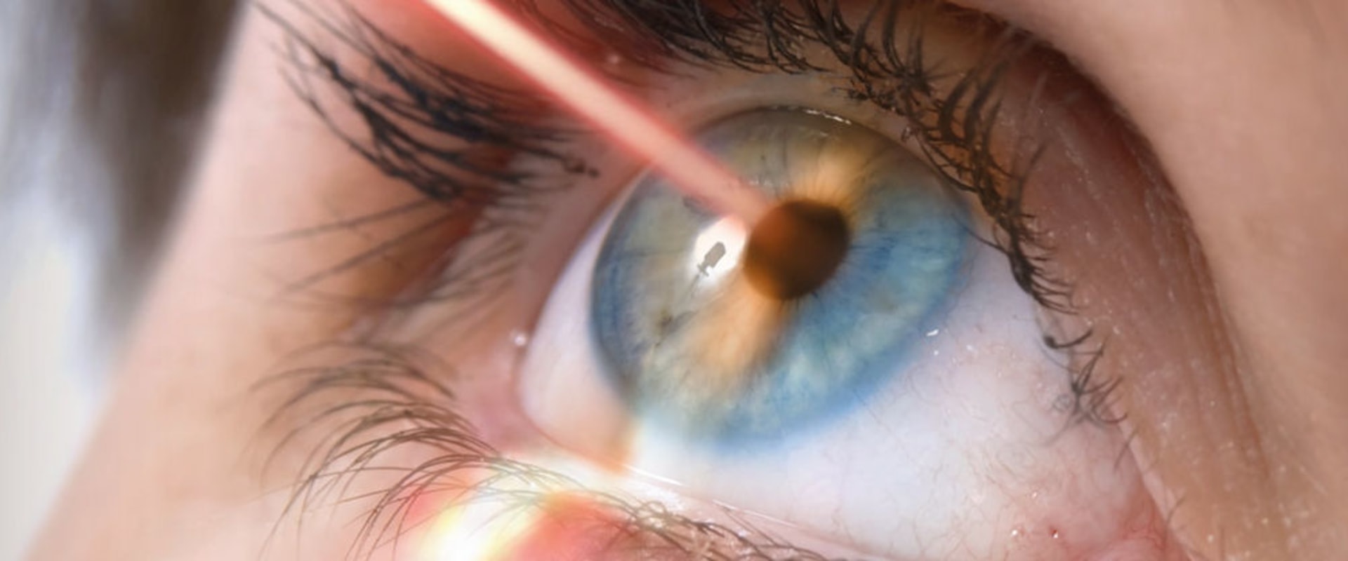 The Advantages of Laser Eye Surgery