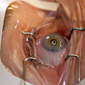 Types of Vision Correction Surgery