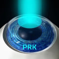 The Higher Cost of PRK Compared to LASIK