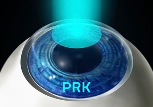 Comparing Costs of PRK and LASIK